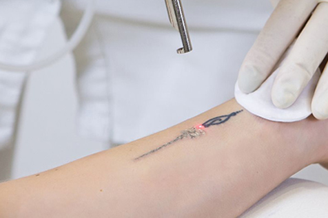 derma-skin-center-therapeftiko-lazer-afairesi-tattoo-thumb