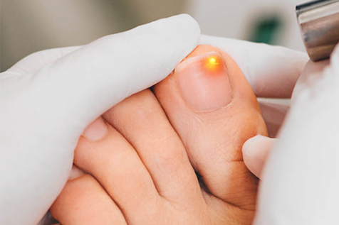 derma-skin-center-therapeftiko-lazer-onyxomykitiasi-thumb