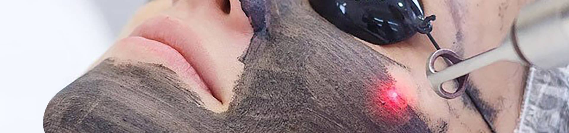 Θεραπεία Λάμψης με Άνθρακα (Hollywood Laser Peel)